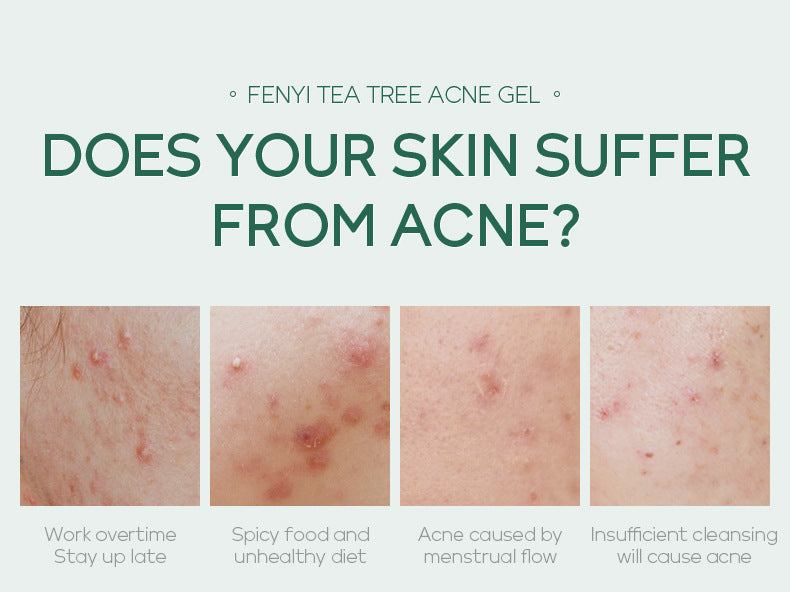 Crema idratante acne